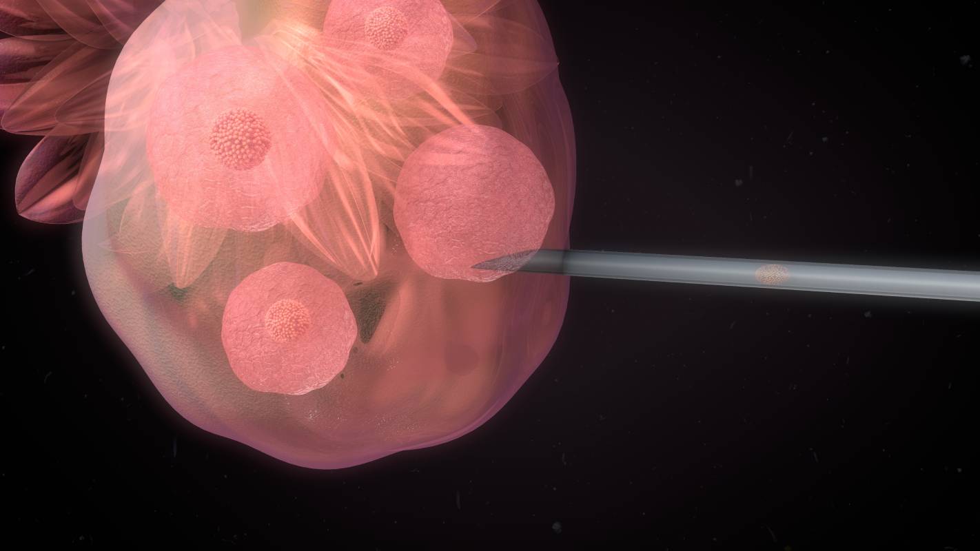 Anesthesia Considerations for IVF 