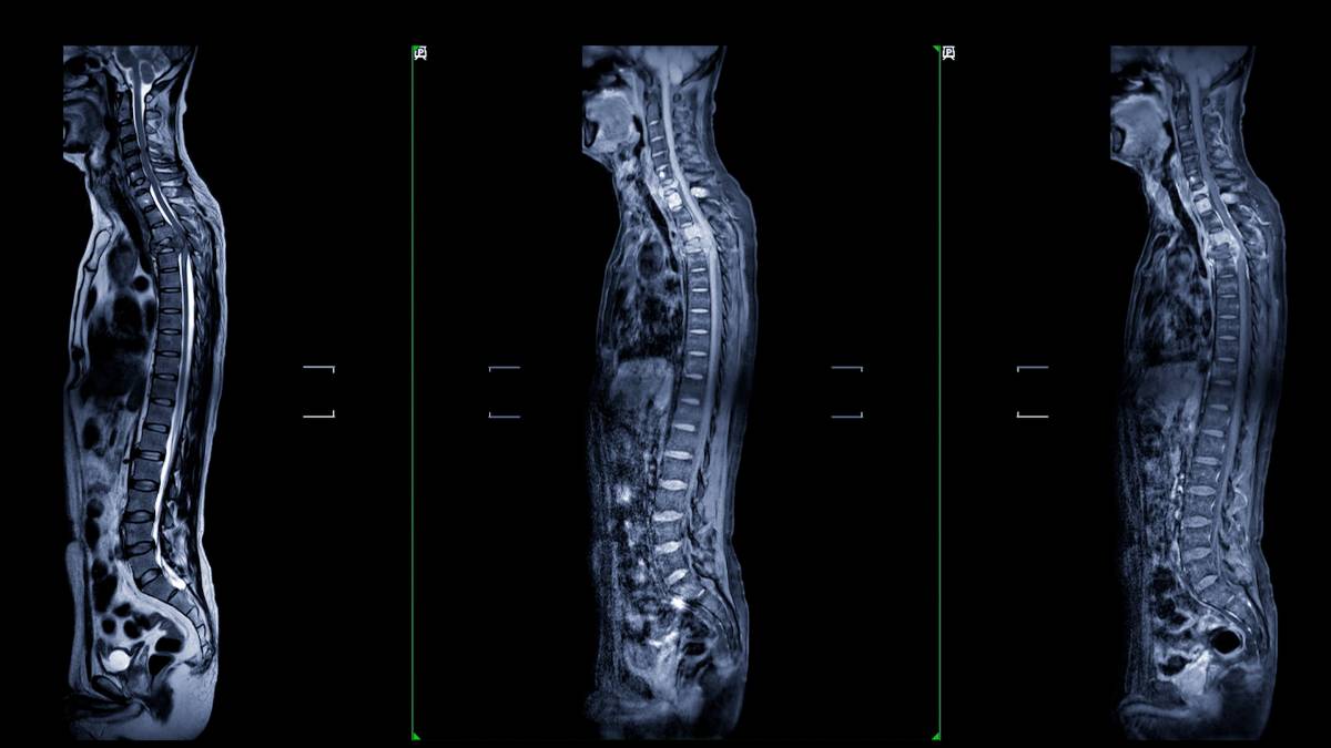What is an Epidurogram?