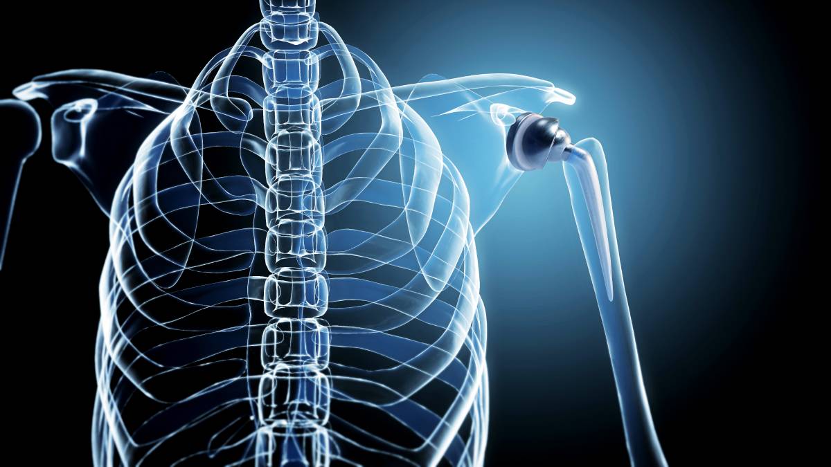 Patient Demographics for Total Shoulder Arthroplasty